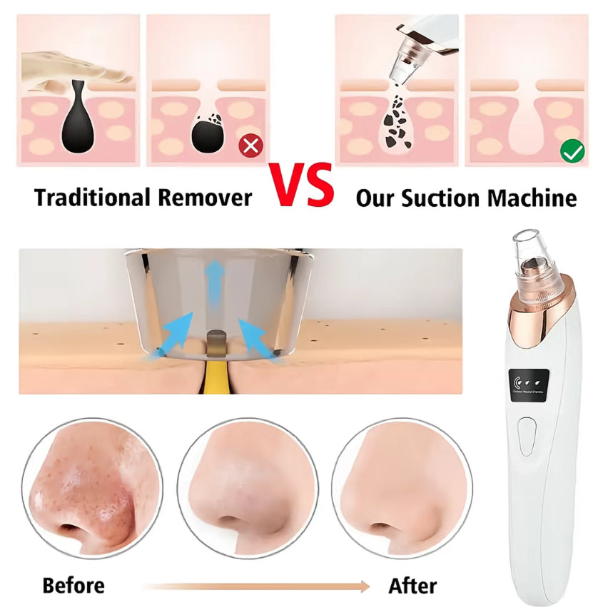 Vacuum Pore Cleaner